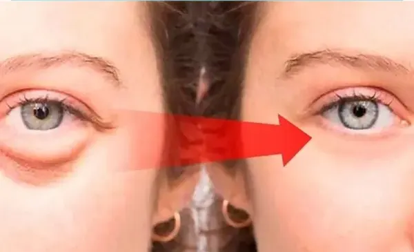 [THÔNG TIN] Cách điều trị bọng mắt an toàn và hiệu quả