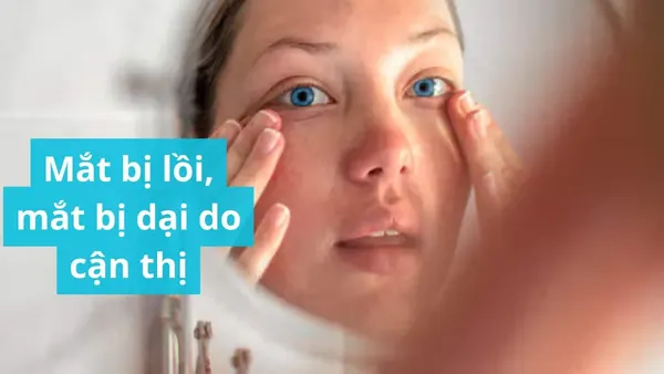 Mắt bị lồi, mắt bị dại do cận thị, nguyên nhân do đâu?